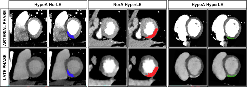 Appearance of myocarditis lesions on spectral CT arterial acquisitions and correlation with edema on MRI.