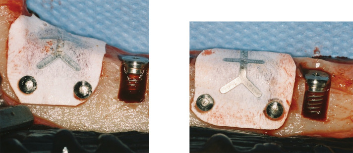 Influence of residual buccal bone thickness in dehiscence defects on osseointegrated dental implants in healed sites: an experimental in vivo study.