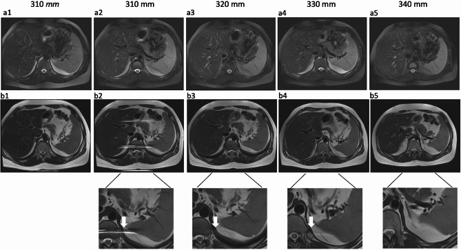 Optimized deep learning-accelerated single-breath-hold abdominal HASTE with and without fat saturation improves and accelerates abdominal imaging at 3 Tesla.