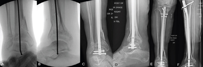 Tibiotalar Nailing for Geriatric Pilon Fractures: Case Report and Review of the Literature.