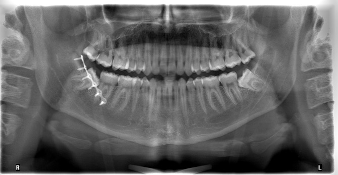 One-plate versus two-plate fixation in the treatment of mandibular angle fractures: a retrospective two-centre comparative study.
