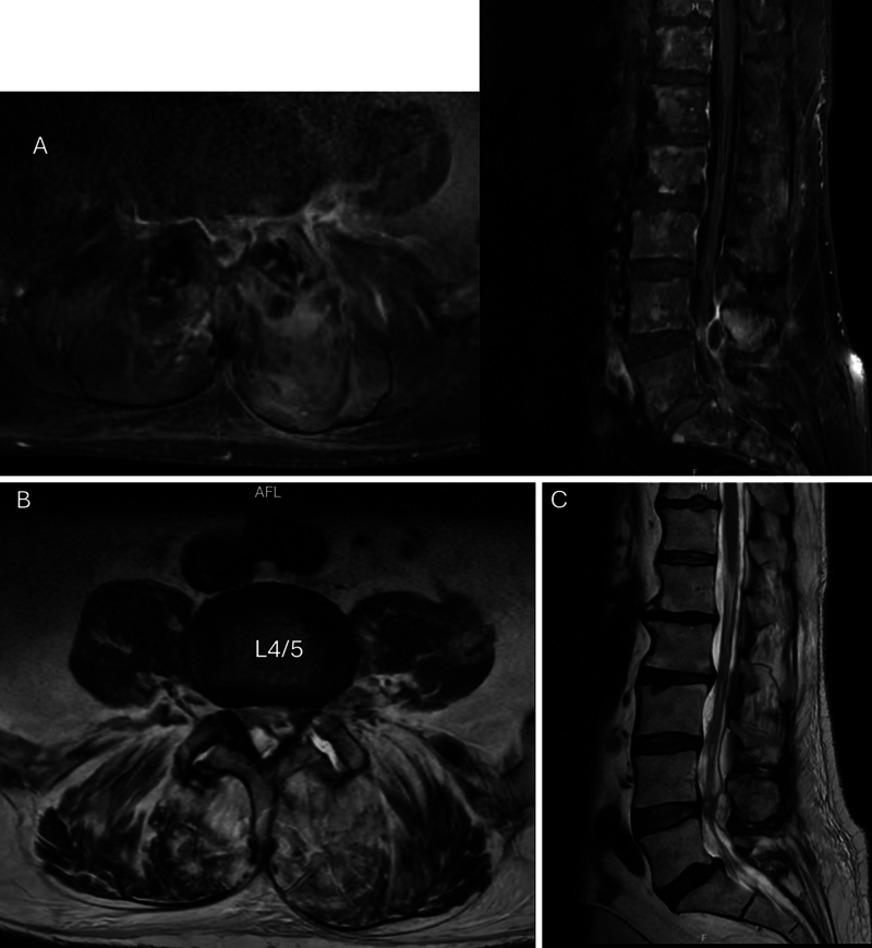 Nocardia facet sepsis, an indicator of immunocompromise: illustrative case.