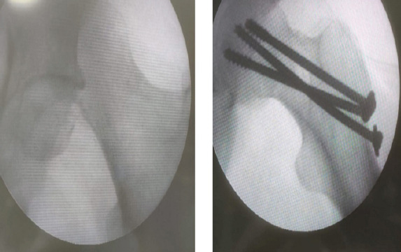 Extraarticular Interfragmentary Fixation of an Irreducible Pipkin Type 1 Fracture Dislocation of the Hip - A Case Report.