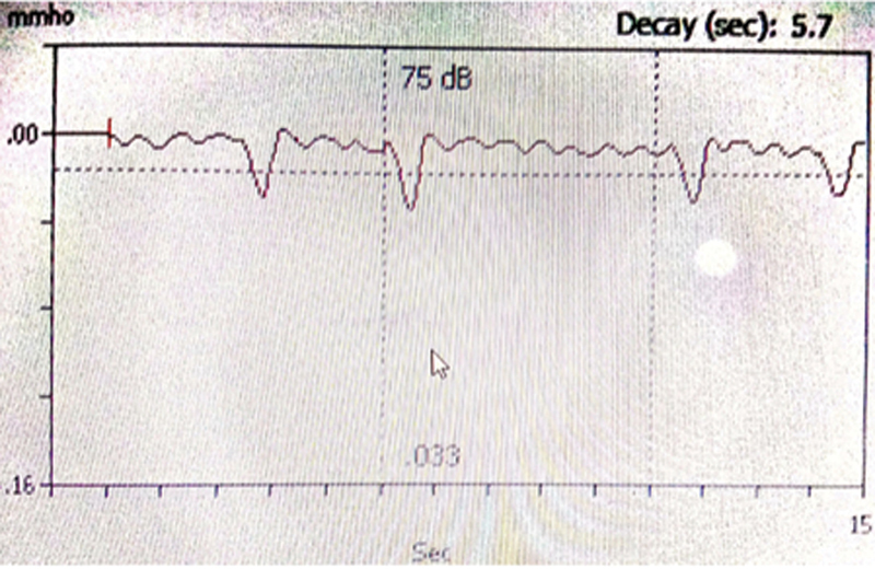 Electrical Stapedial Reflex Thresholds in Cochlear Implant Recipients with Cochlear Nerve Deficiency: A Retrospective Study.