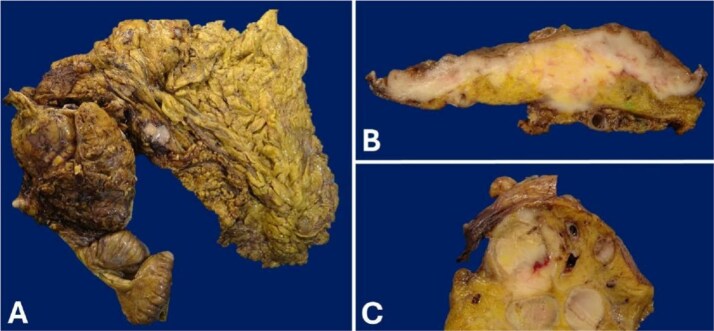 Primary colonic lymphoma: clinical dilemmas in diagnosis and treatment strategy.