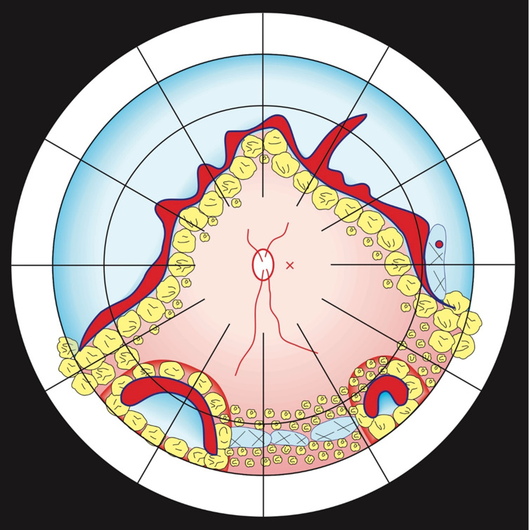 A Challenging Approach: Iris Neovascularization and Vitreous Hemorrhage 40 Years after Treatment of Retinal Giant Tear Detachment.