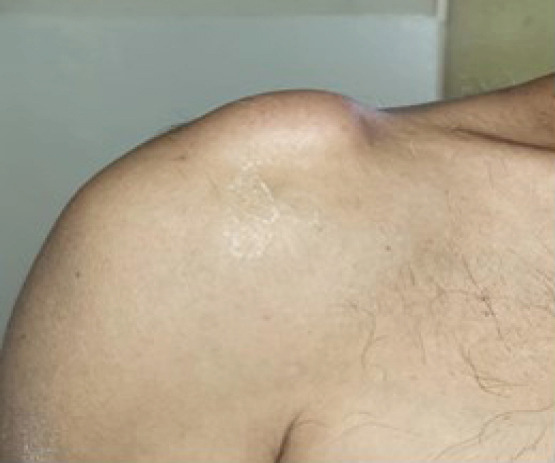 A Silent Shoulder of Plentiful Pathology: An Uncommon Presentation of Acromioclavicular Ganglion Cyst.