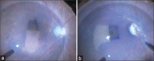 Comparison of superior and temporal inverted internal limiting membrane techniques in macular hole surgery: Surgical outcomes and the role of postoperative positioning.