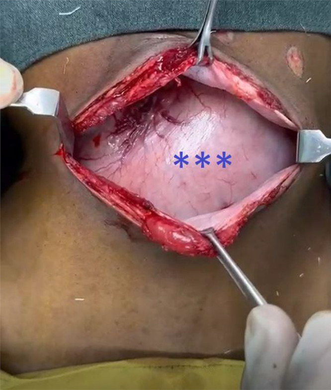 Annular Pancreas in a 13-Year-Old Boy: A Delayed Clinical Presentation of a Congenital Anomaly Highlighting Challenges of Diagnosis.