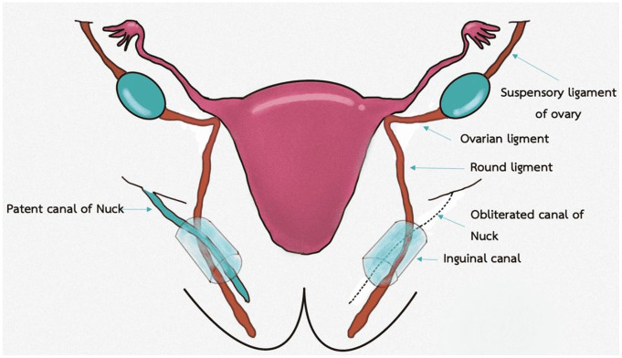 Hydrocele of the Canal of Nuck: A Rare Etiology of Inguino-Labial Swelling in a Young Female: A Case Report.