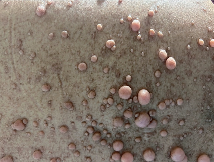 A Case of Neurofibromatosis Type 1 With Early Gastric Cancer and Multiple Small Bowel Gastrointestinal Stromal Tumors.