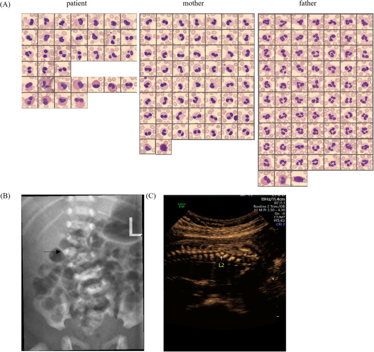 Novel lamin B receptor mutation (c.561C > G) in a patient with Pelger-Huët anomaly: a case report.