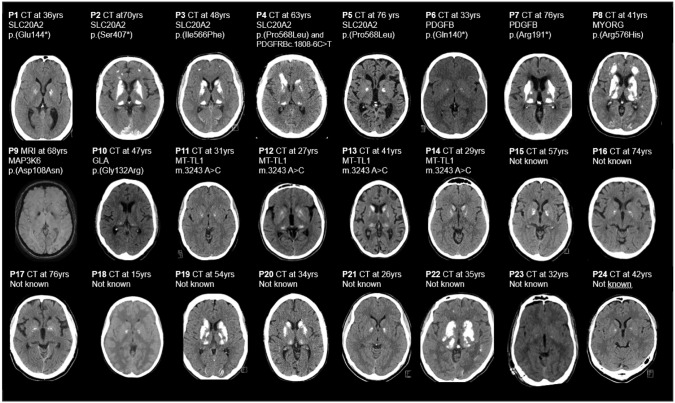 Genetic background of neurological disorders with basal ganglia calcification.