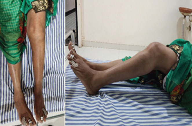 Total Knee Arthroplasty in Tuberculous Arthritis of the Knee - A Case Report.