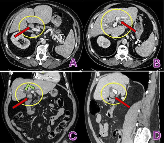 Diagnosis of Perihilar Osteoclast Giant Cell Carcinoma in an Elderly Patient: A Report of Diagnostic Challenges Over Several Attempts.