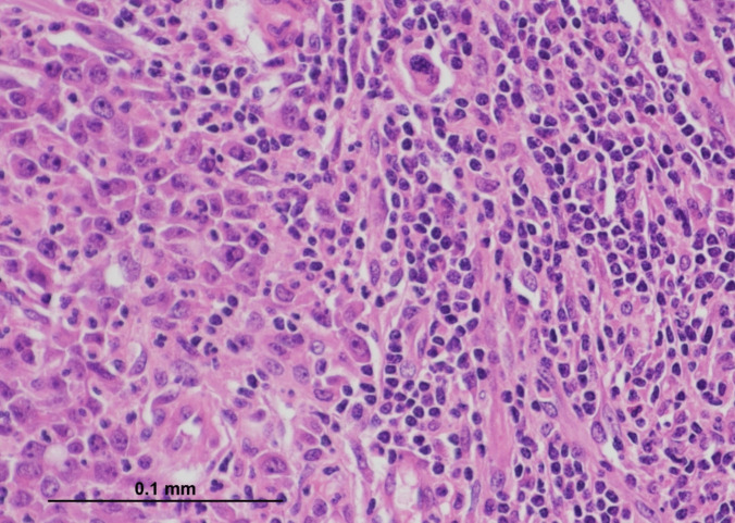 Medullary Carcinoma of the Colon: Not as Favourable as Previously Thought?