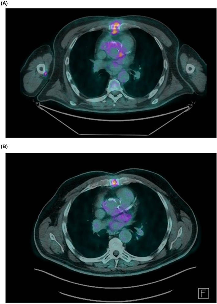 Rezafungin Utilisation in Real Life-FungiScope Results From Europe and the United States.