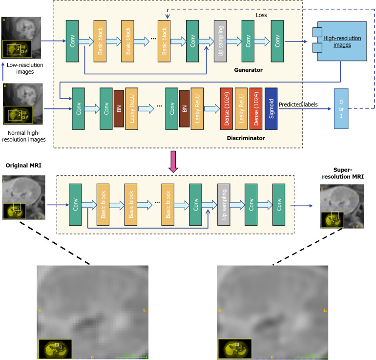 Multiparametric magnetic resonance imaging of deep learning-based super-resolution reconstruction for predicting histopathologic grade in hepatocellular carcinoma.