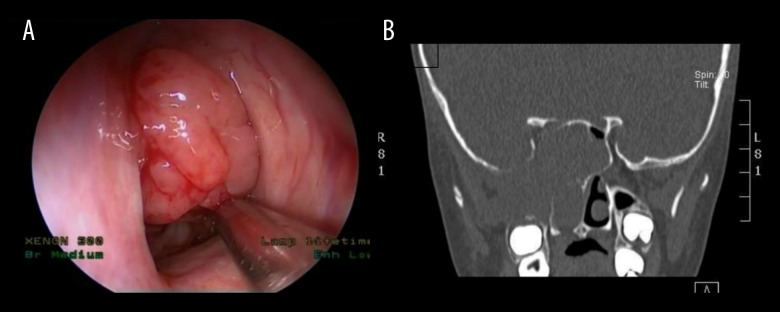 Retrospective Study of Pediatric Sinonasal Tumors in a Tertiary Hospital Setting.