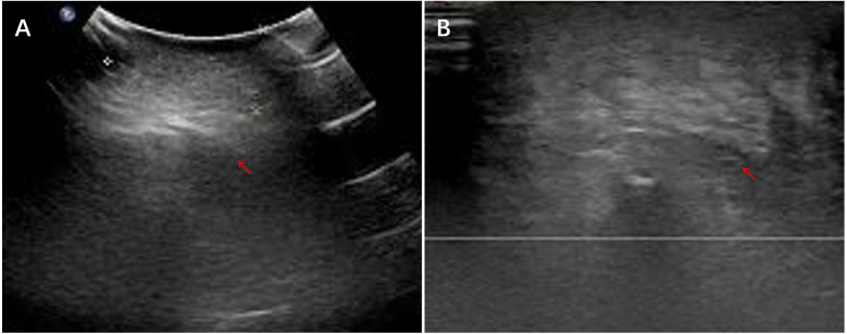Inflammatory myofibroblastic tumors in children: a single-center retrospective study of clinical features, management, and outcomes.
