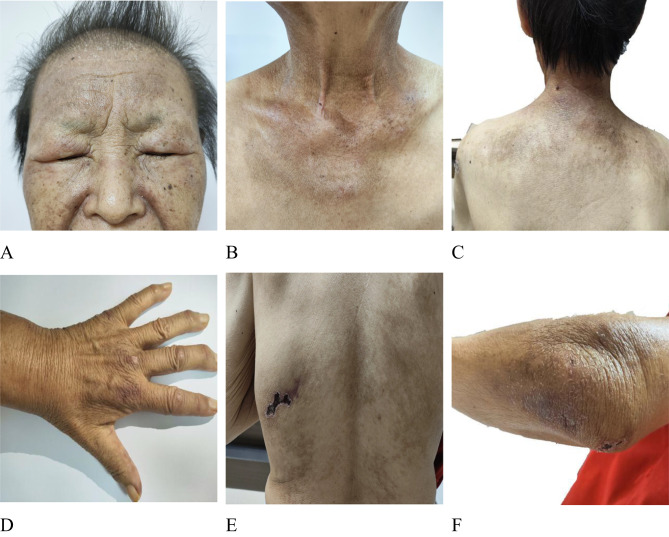 Anti-MDA5 Positive Dermatomyositis Overlapping with Rheumatoid Arthritis: A Case Report.