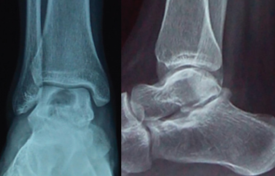 Aneurysmal Bone Cyst of Talus: A Case Report.
