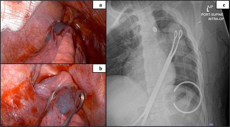 Case study: robotic foreign body removal of bullet in the aortopulmonary window.