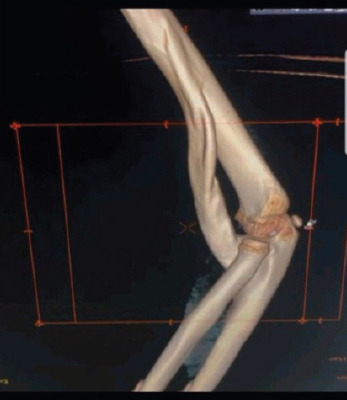 Humeroulnar Bridging Myositis Ossificans Traumatica: A Case Report.