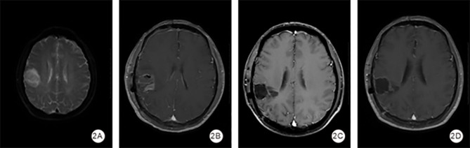 The Predictive Value of ADC Values, Degree of Edema and the Systemic Immune-Inflammation Index for Early Postoperative Recurrence in High-Grade Gliomas.