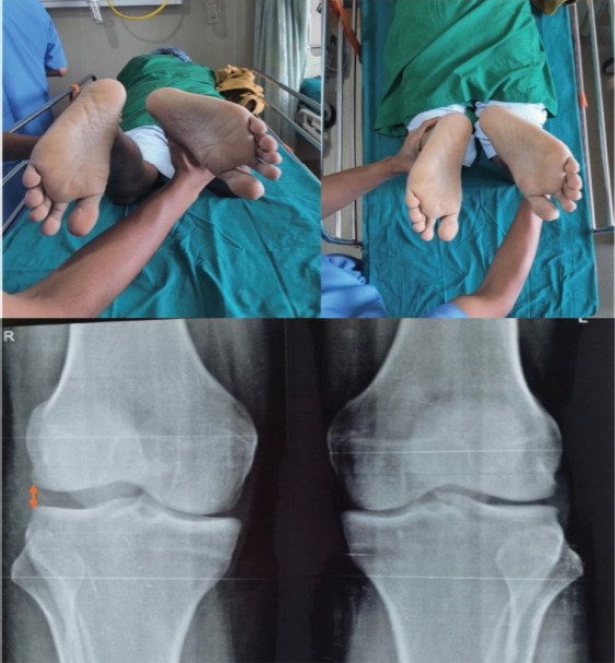 Finding the Optimal Balance - Isolated Posterolateral Corner Reconstruction with Allograft Tendon in a Combined Posterolateral Corner-Posterior Cruciate Ligament Injury: A Case Report.