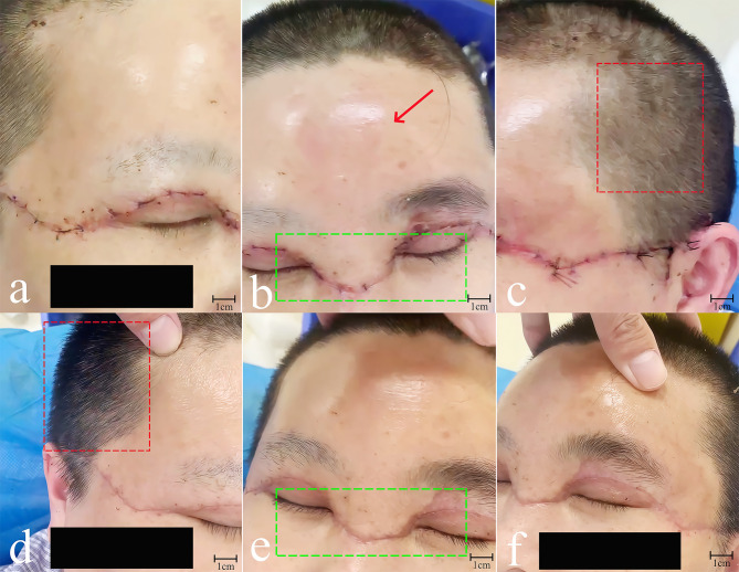 Treatment of severe scalp avulsion injury through microsurgical vascular anastomosis, subarea multi-tubenegative pressure drainage, and anchoring sutures: a case report.