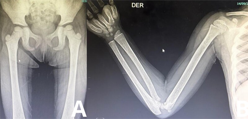 A rare case of Langerhans cell histiocytosis with unexplained endocrine dysfunction and extensive skeletal involvement in a Pediatric patient.