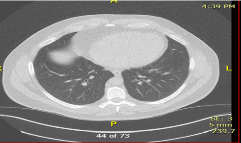 Pulmonary Aspergillosis Mimicking Metastatic RCC: A Postnephrectomy Diagnostic Consideration.