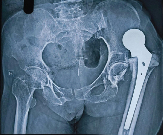 The Price of Poor Cementing: A Case Report on Chronic Hip Dislocation and Revision.