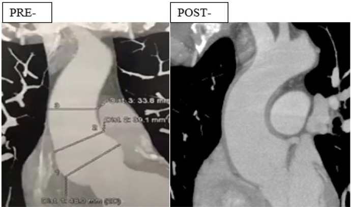 Personalized External Aortic Root Support (PEARS) in the Treatment of Marfan Syndrome and Bicuspid Aortic Valve Aneurysms: First Case Series in the American Continent.
