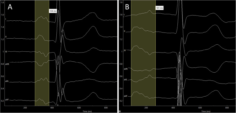 ECG-based identification of COPD patients at risk for atrial fibrillation and its impact on adverse clinical outcomes-a subgroup analysis of the prospective multicenter COSYCONET cohort.