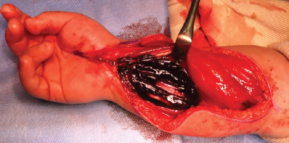 Acute Forearm Compartment Syndrome in a Toddler Caused by Hematoma without Fracture: A Case Report.