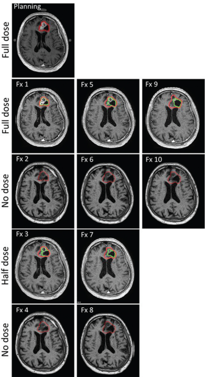 Feasibility of a reduced gadolinium dose protocol for MRI-guided radiotherapy in glioblastoma.