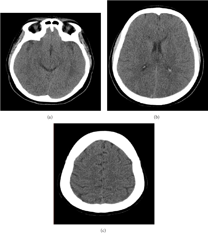 Cerebral Venous Thrombosis Following Periocular Filler Injection-A Case Report and Review of Literature.