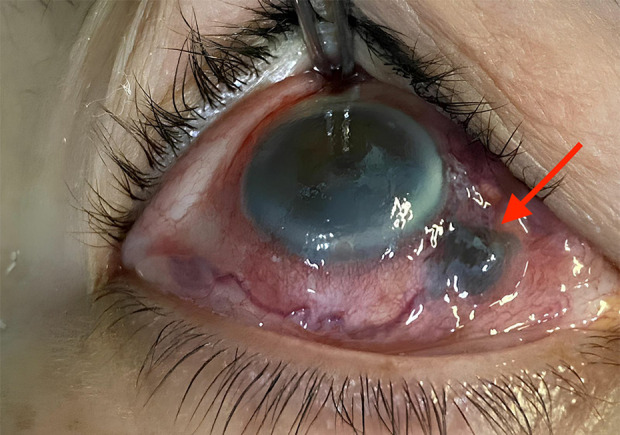 Progressive Vision Loss From Uveal Melanoma with Extraocular Extension: A Case Report.