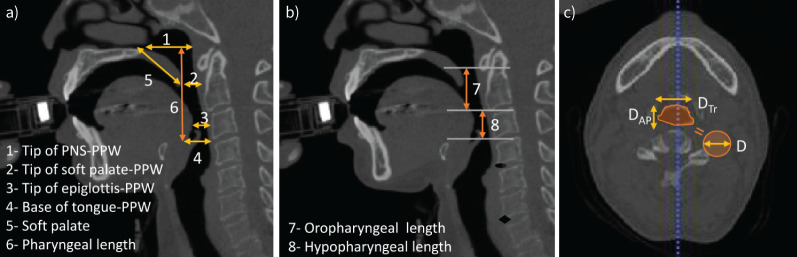 Oropharyngeal enlargement in obstructive lung disease: quantification and machine learning.