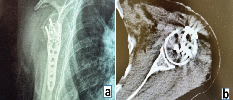 Irreducible Anterior Shoulder Dislocation with Greater Tuberosity Fracture: Joystick Reduction and Biceps Preservation in an Elderly Female -A Case Report.