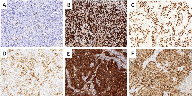 SMARCA2 Deficiency While Preserving SMARCA4 in Lung Adenocarcinoma Combined with Abnormal β-Catenin Expression.