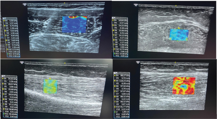 The effect of short-term treatment with botulinum toxin a on muscle stiffness in stroke patients: an exploratory study.