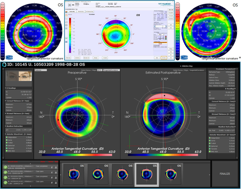 A case series study of laser refractive corneal surgery assisted by a virtual postoperative corneal simulation.