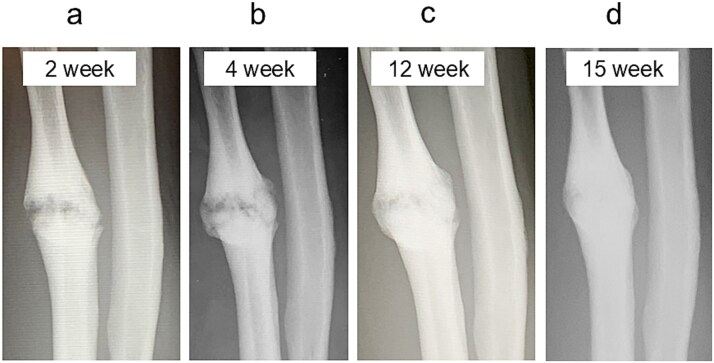 Bone union achieved in an ulnar shaft nonunion using dextrose prolotherapy without surgery: a case report.