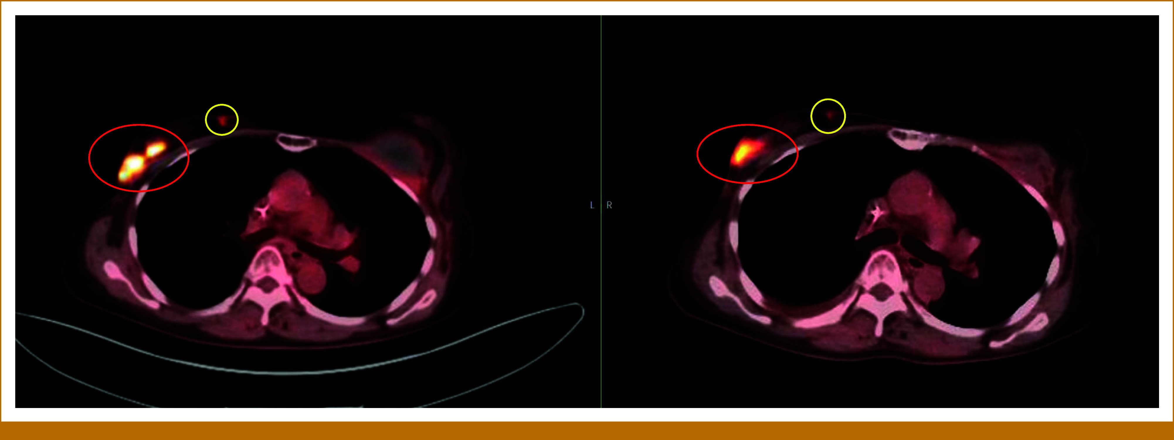 Complete Response With Alpelisib and Trastuzumab in a Patient With Estrogen Receptor-/Progesterone Receptor-Negative, Human Epidermal Growth Factor Receptor 2-Positive Refractory Metastatic Breast Cancer.