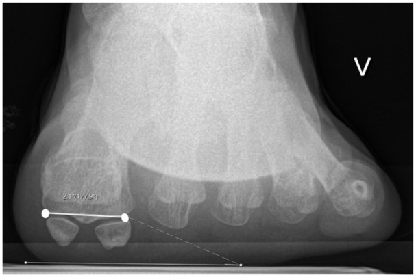 Metatarsal Pronation on Radiographs: A Prospective Reliability Study of Visual Rotation Markers in Hallux Valgus.