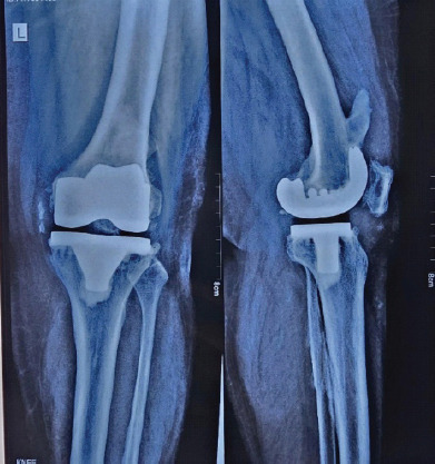 Rare Case of Heterotopic Ossification Impinging on the Quadriceps Mechanism Following Total Knee Replacement: A Case Report.