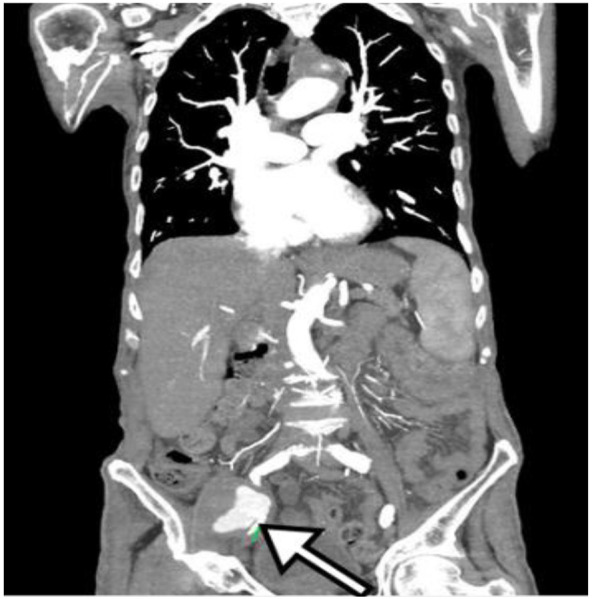 <i>Mycobacterium bovis</i>, a rare causative pathogen of multiple pseudoaneurysms.